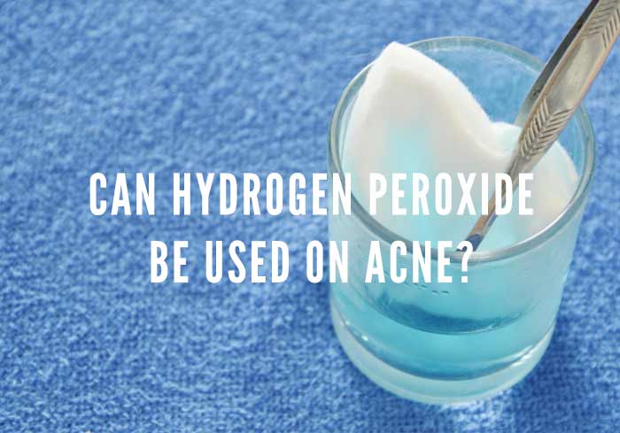 hydrogen peroxide on acne