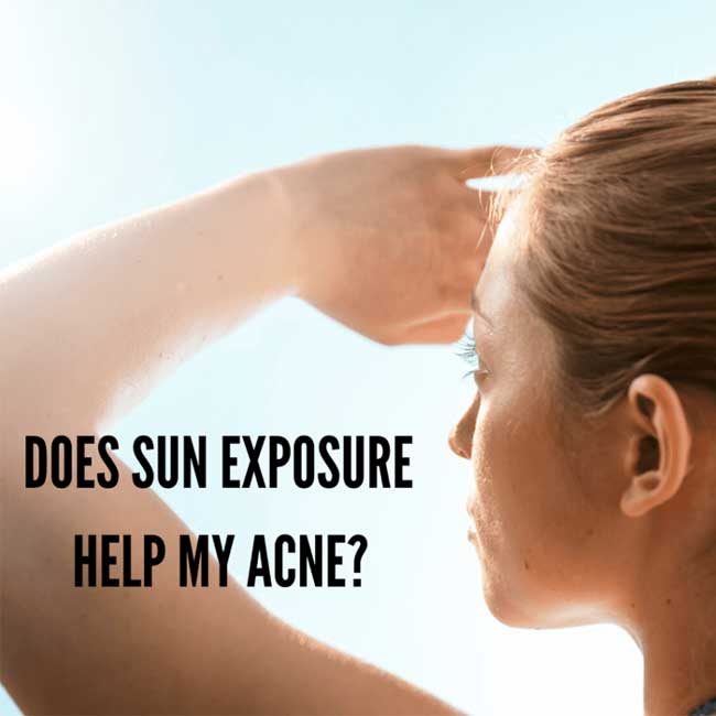 sun exposure and acne