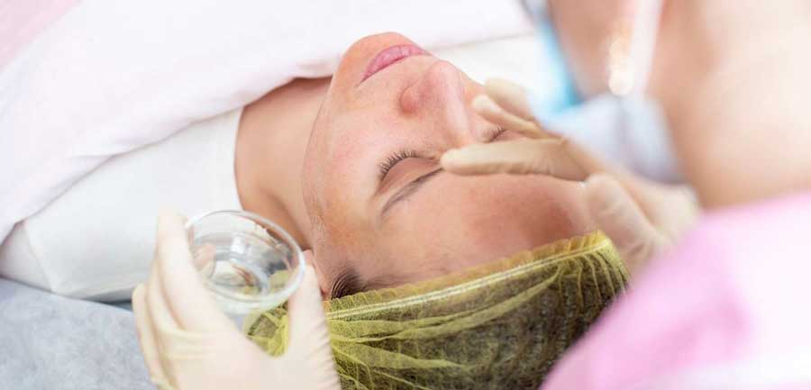 chemical peel