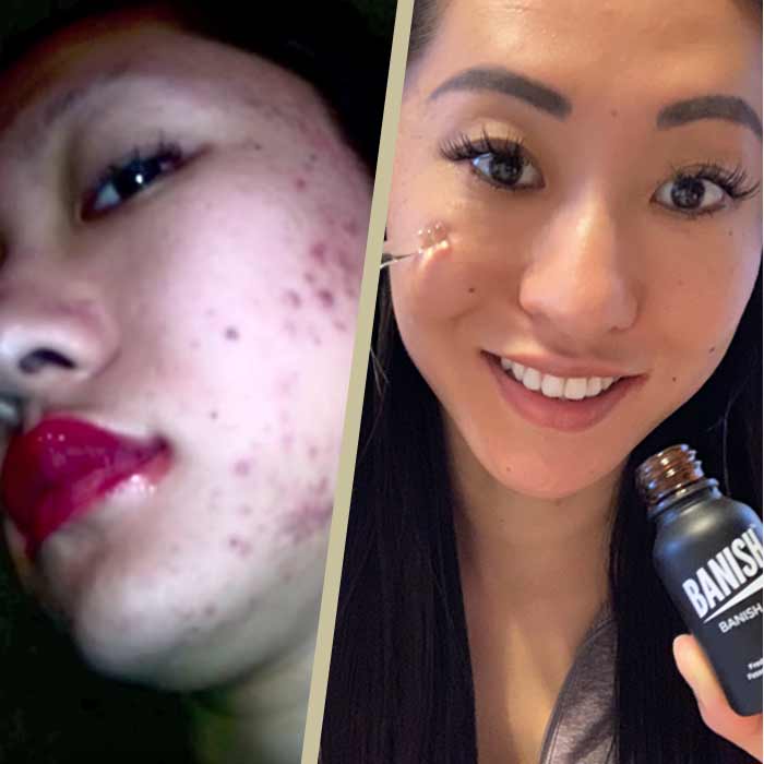 How To Create A Skin Care Routine For Acne Scars