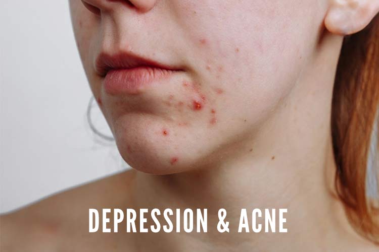 How Acne Can Cause Depression? Link Between Depression and Acne