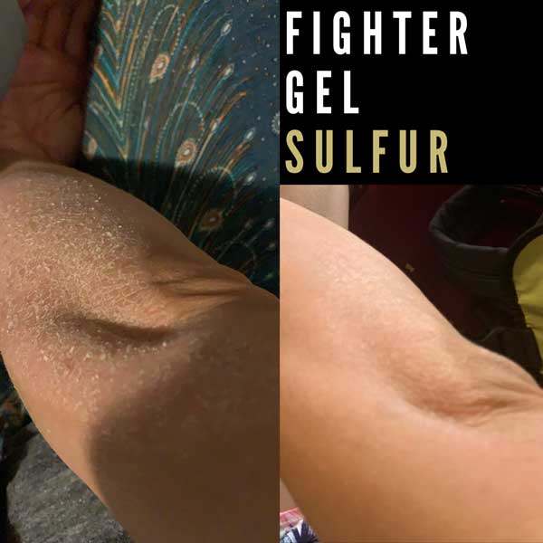 banish fighter gel on eczema results
