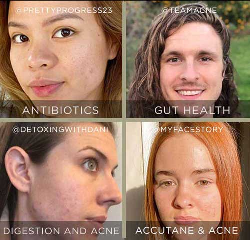 how to find right approach to acne