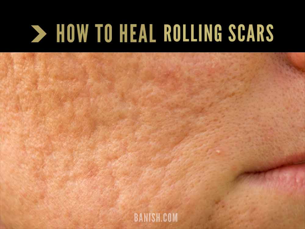 rolling scars