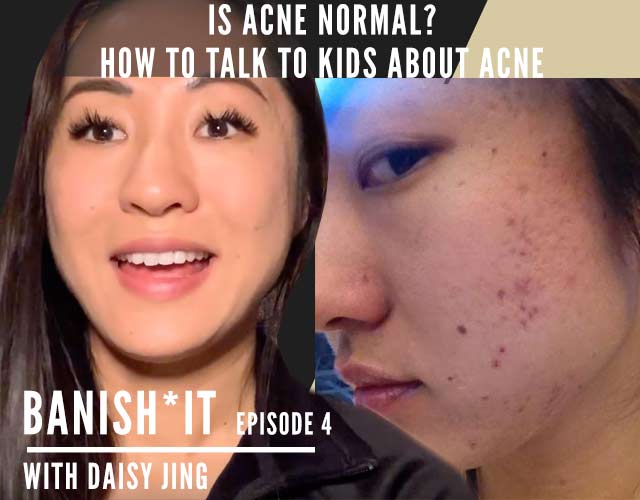 is acne normal  banish it podcast