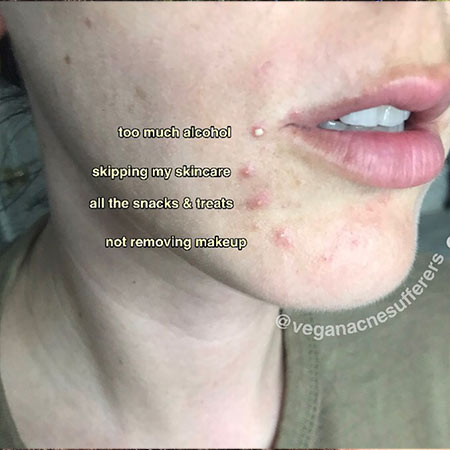 acne breakouts on chin