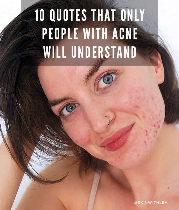 banish acne quotes