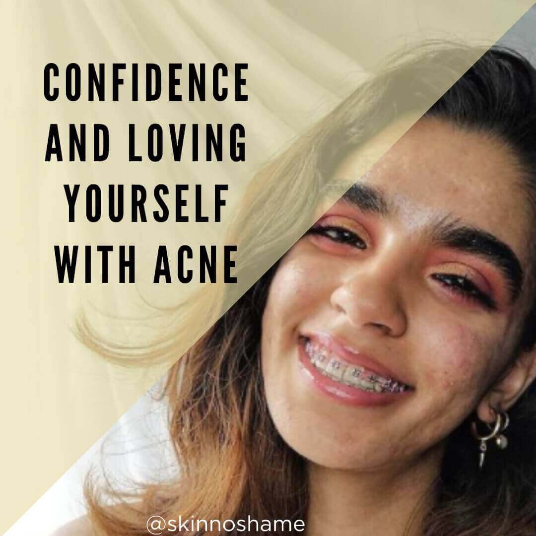 confidence with acne