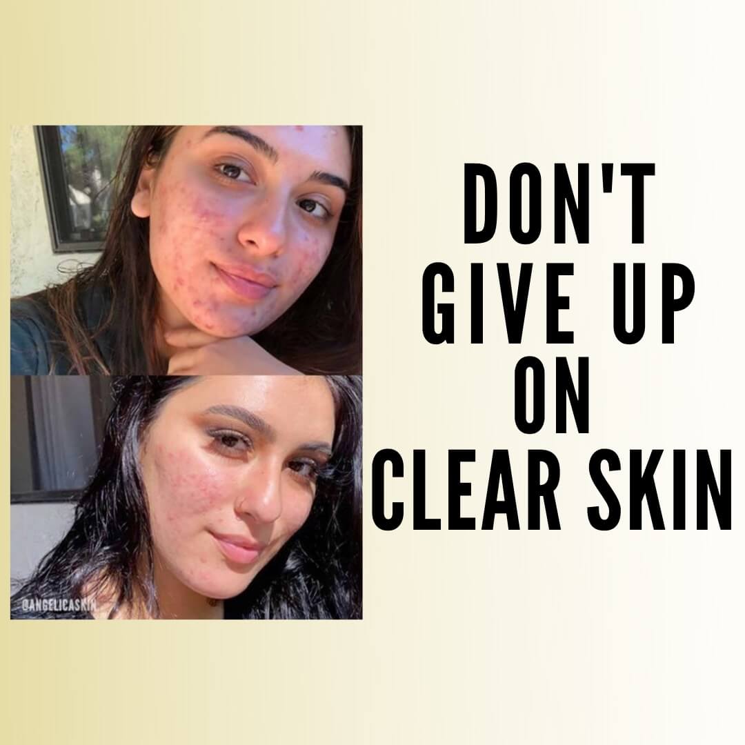 how to achieve clear skin