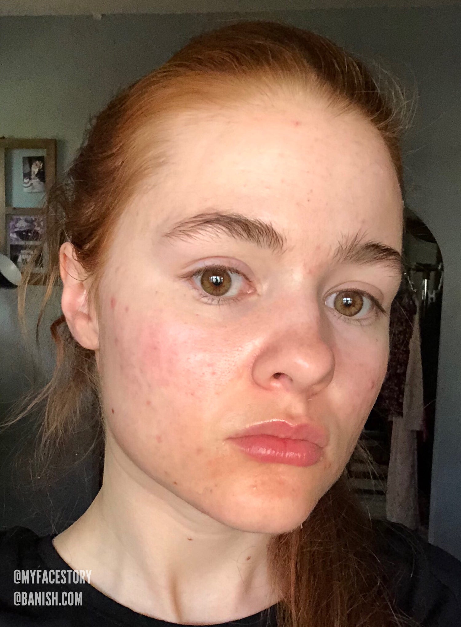 Why Showing Off Your Acne on Instagram is the Hot New Trend You WANT to Try