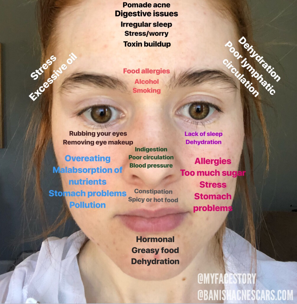 face mapping for acne