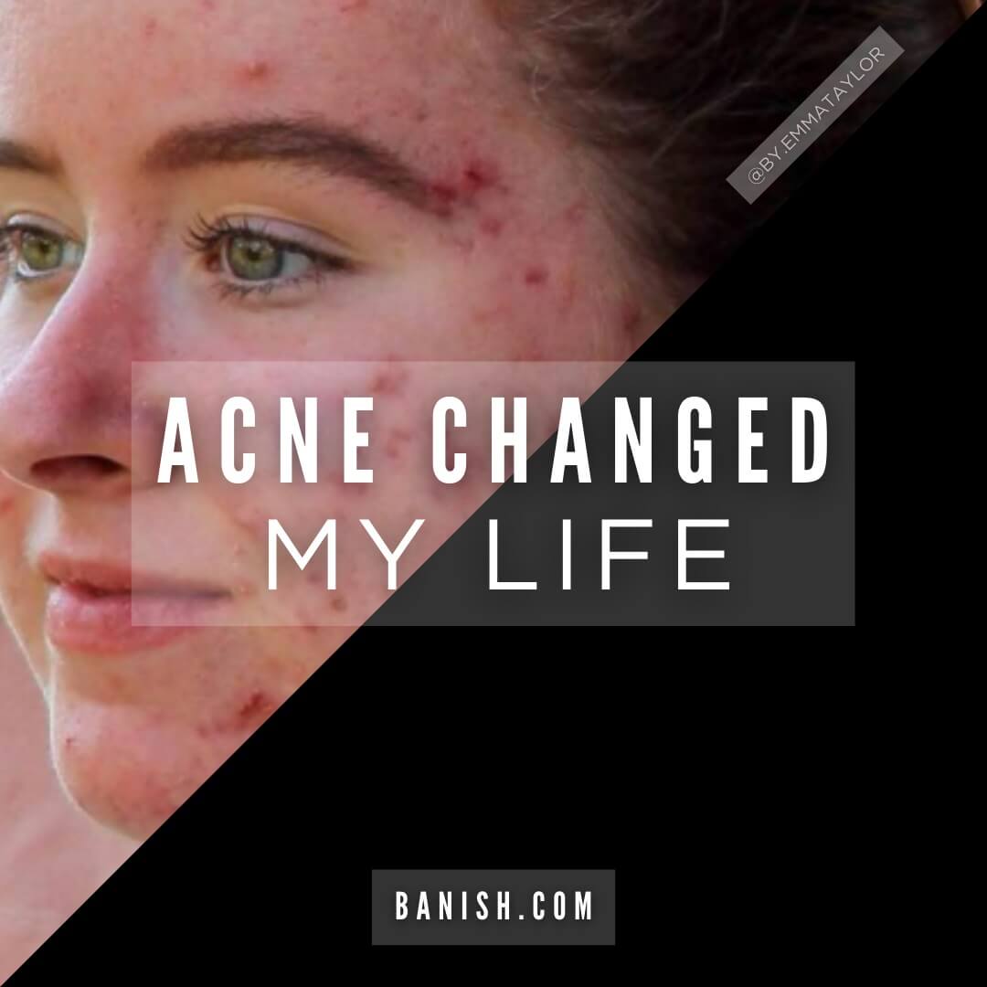 How does acne affect a person's life