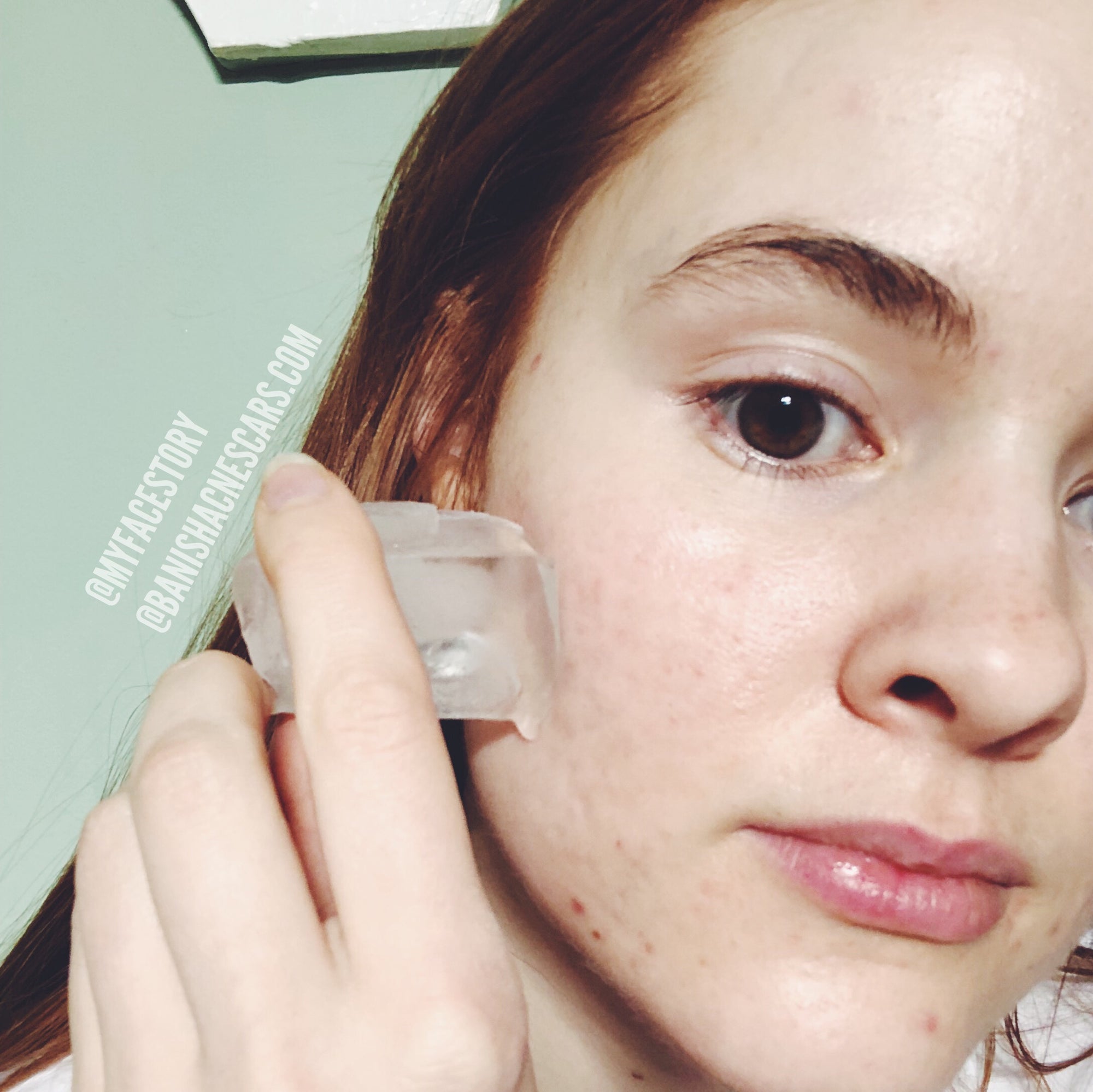how to prevent acne scars