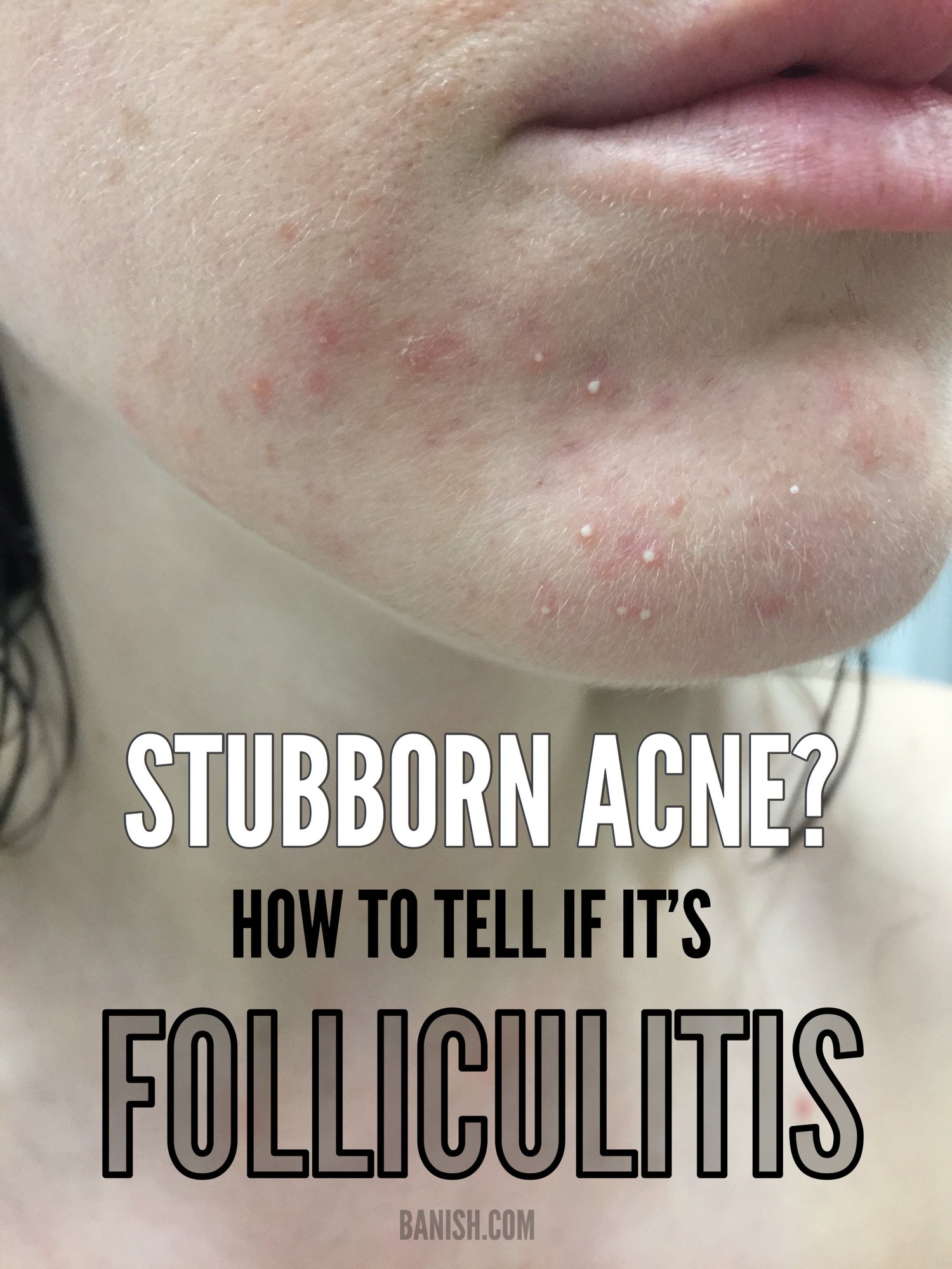 Stubborn Acne? It Could Be Folliculitis