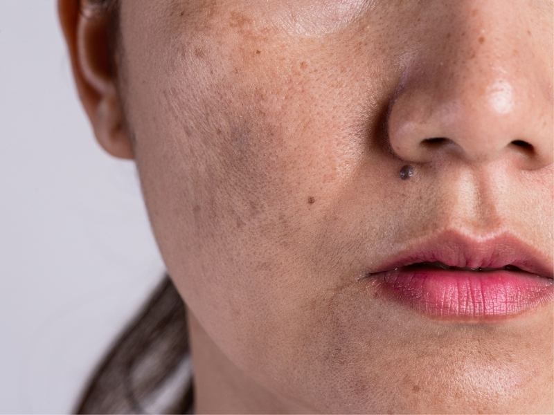 Melasma: Ways To Treat and Fade Melasma