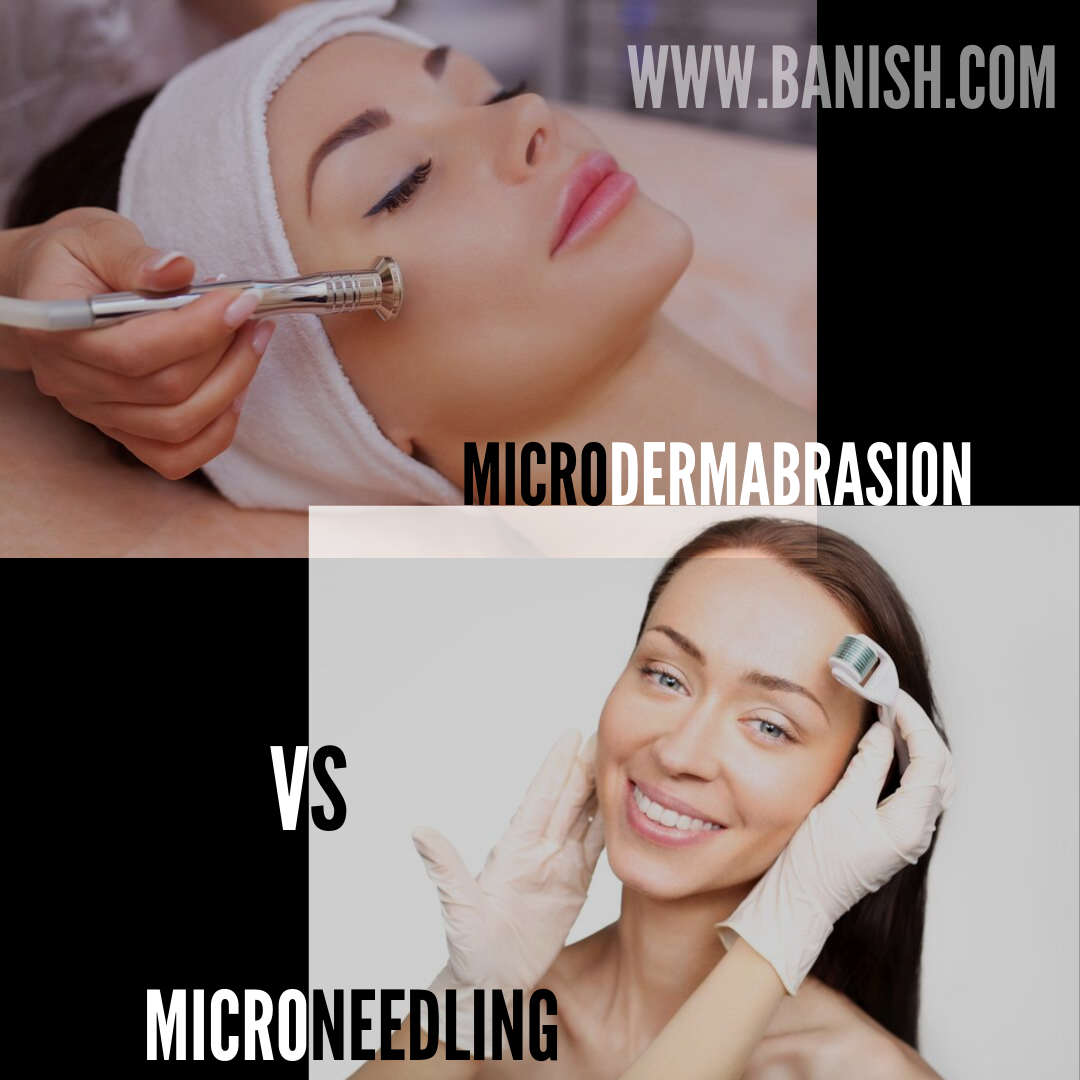 Is Microdermabrasion an Effective Treatment for Acne Scars?