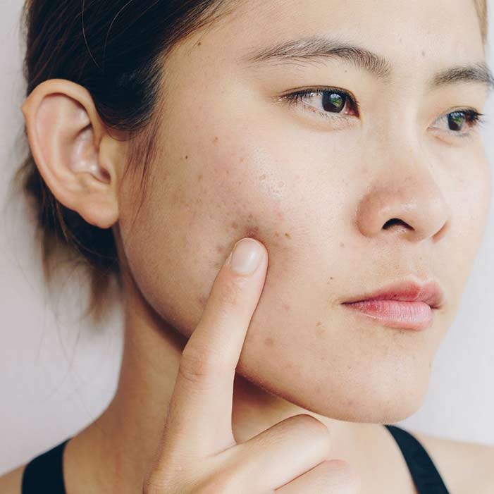 skin barrier acne