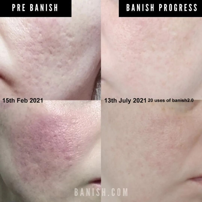 Banish before after acne scars