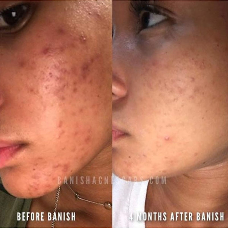 Banish before after dark spots