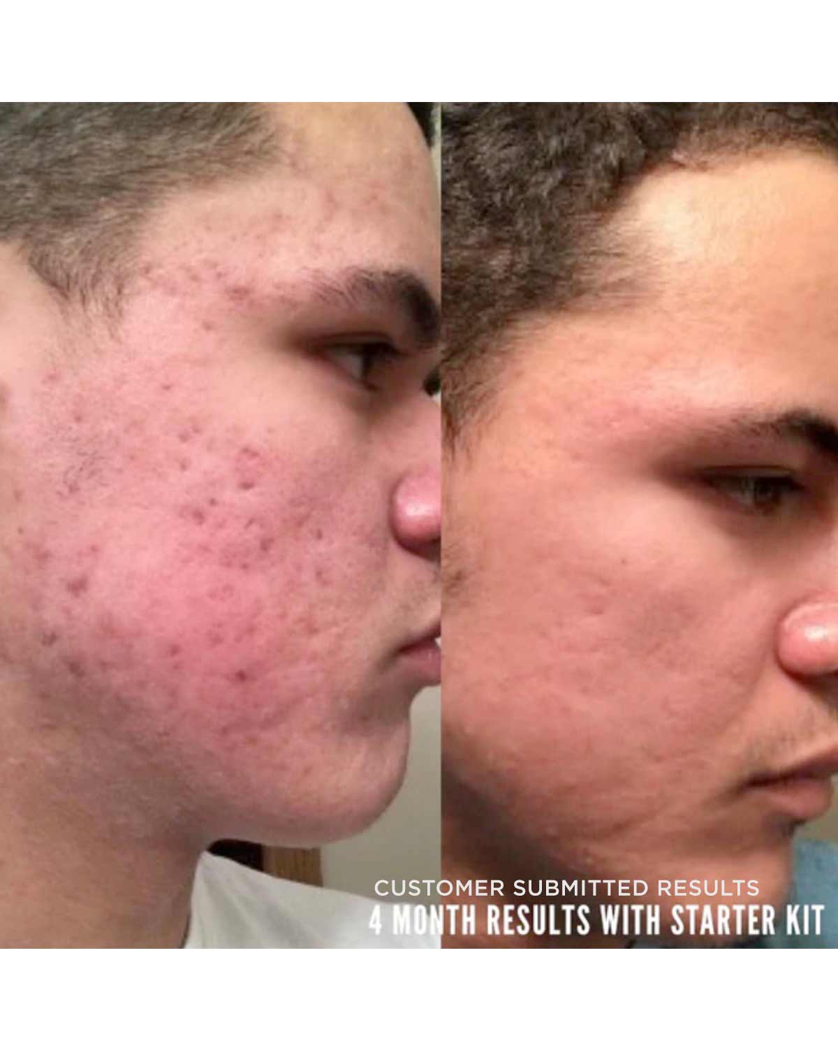 banish starter kit results on acne scars