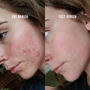 banish before and after scarring and active acne kit