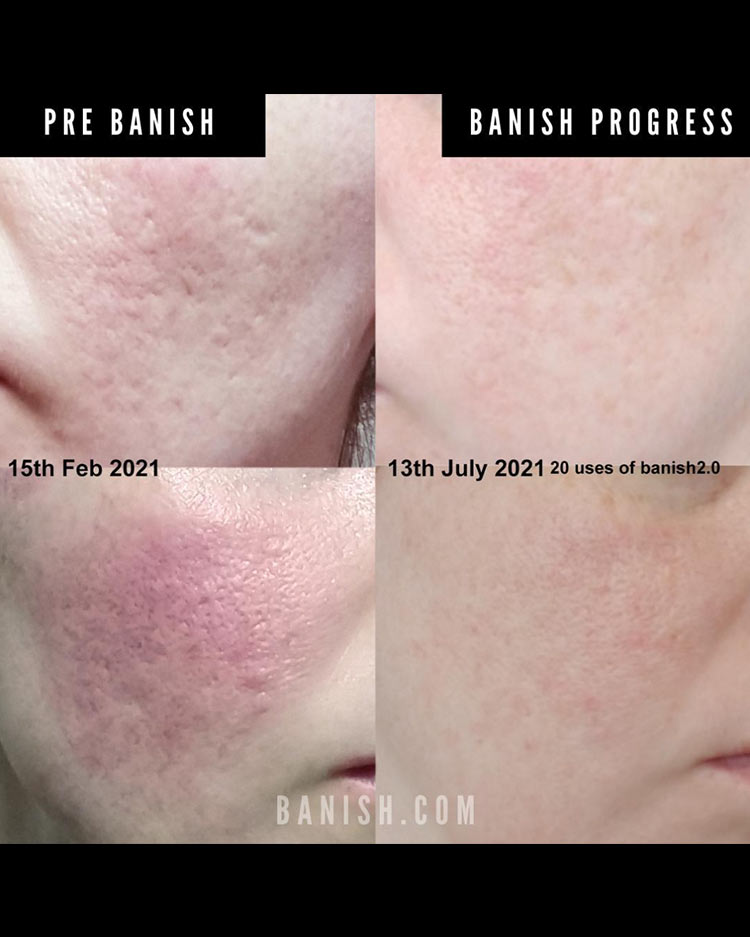 banisher at home microneedle results 