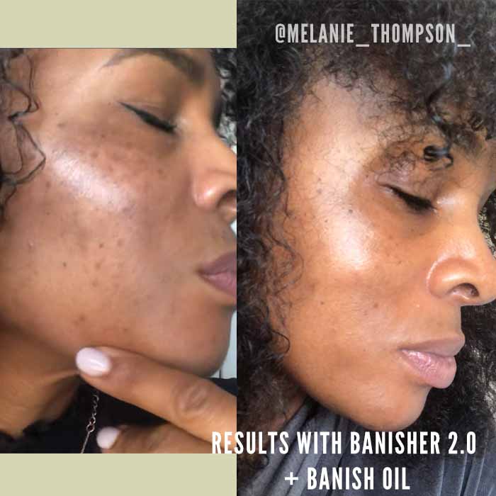 Banisher 2.0 Microneedling Stamp 24k Gold Plated