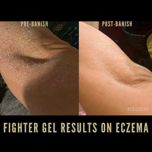 fighter gel for eczema