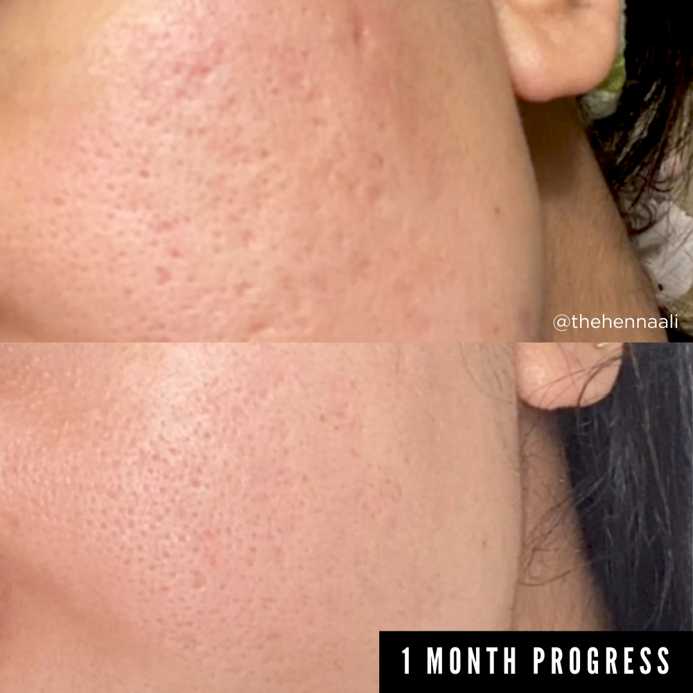 Natural Skincare Products For Acne Scars Reference: Skincare Buy Banish Skincare Natural Products For Acne Scars